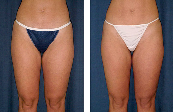 Before And After Photos Mountain View - SmartLipo Image 17