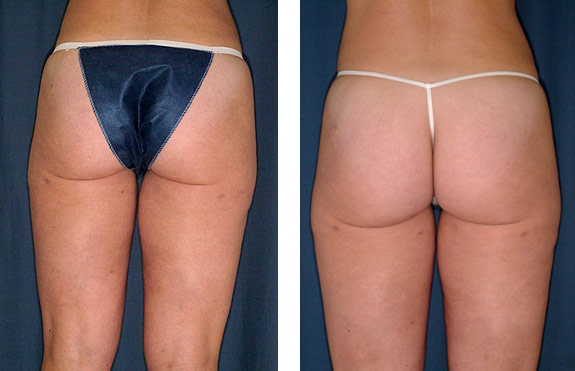 Before And After Photos Mountain View - SmartLipo Image 18