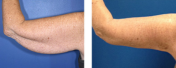 Before And After Photos Mountain View - SmartLipo Image 02