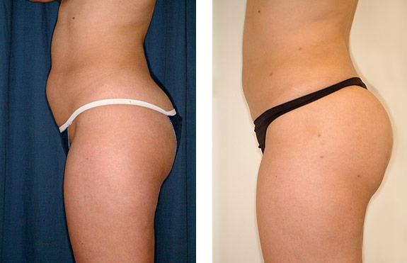 Before And After Photos Mountain View - SmartLipo Image 21