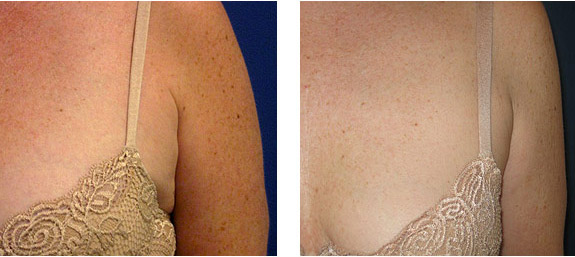 Before And After Photos Mountain View - SmartLipo Image 22