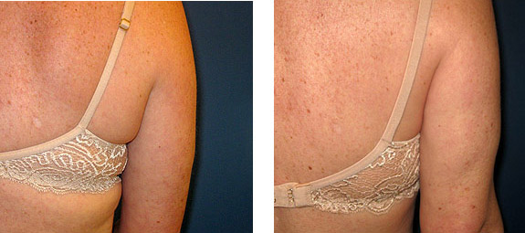 Before And After Photos Mountain View - SmartLipo Image 23