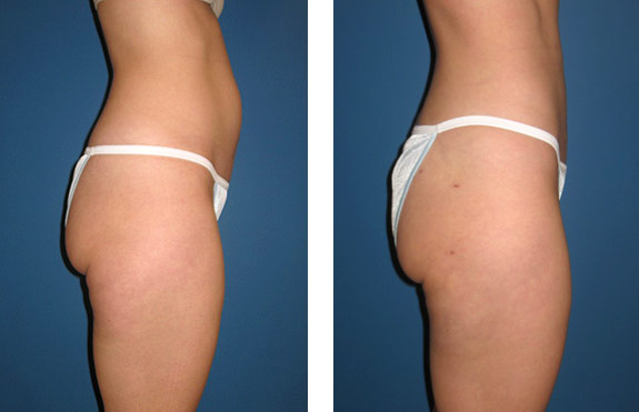 Before And After Photos Mountain View - SmartLipo Image 24