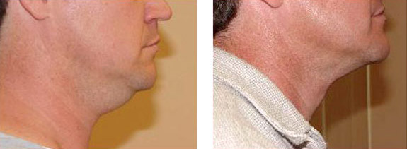 Before And After Photos Mountain View - SmartLipo Image 26