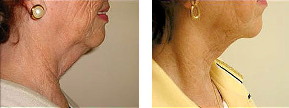 Before And After Photos Mountain View - SmartLipo Image 27