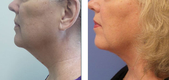 Before And After Photos Mountain View - SmartLipo Image 28