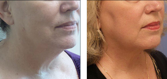 Before And After Photos Mountain View - SmartLipo Image 29