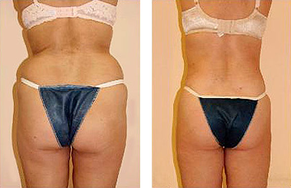 Before And After Photos Mountain View - SmartLipo Image 03