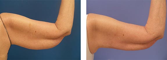 Before And After Photos Mountain View - SmartLipo Image 30