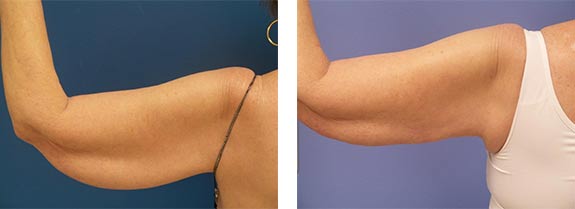 Before And After Photos Mountain View - SmartLipo Image 31