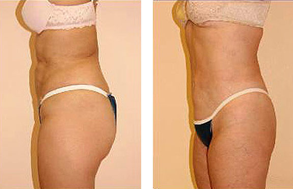 Before And After Photos Mountain View - SmartLipo Image 04