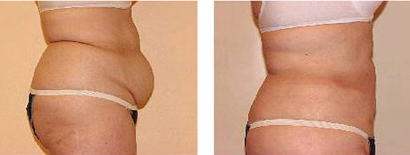 Before And After Photos Mountain View - SmartLipo Image 05