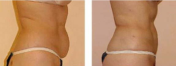Before And After Photos Mountain View - SmartLipo Image 06