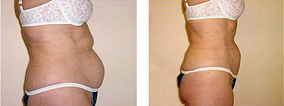 Before And After Photos Mountain View - SmartLipo Image 07
