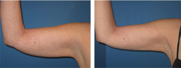 Before And After Photos Mountain View - SmartLipo Image 09