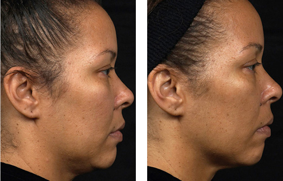 Before And After Photos Mountain View - Thermage Image 3