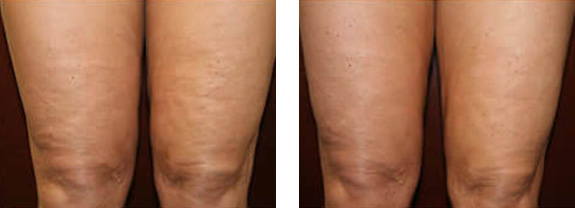 Before And After Photos Mountain View - Thermage Image 5