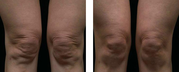 Before And After Photos Mountain View - Thermage Image 6