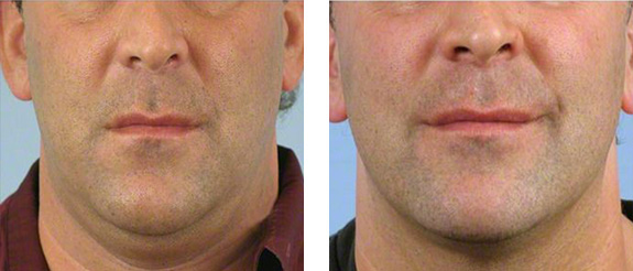 Before And After Photos Mountain View - Thermage Image 7