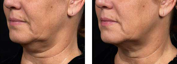 Before And After Photos Mountain View - Thermage Image 8