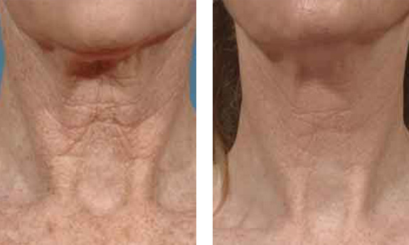 Before And After Photos Mountain View - Thermage Image 1