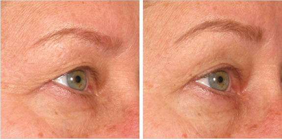 Before And After Photos Mountain View - Ultherapy - Brows Image 01