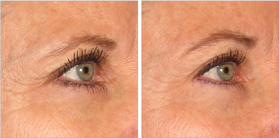 Before And After Photos Mountain View - Ultherapy - Brows Image 10