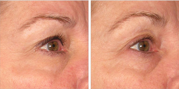Before And After Photos Mountain View - Ultherapy - Brows Image 11