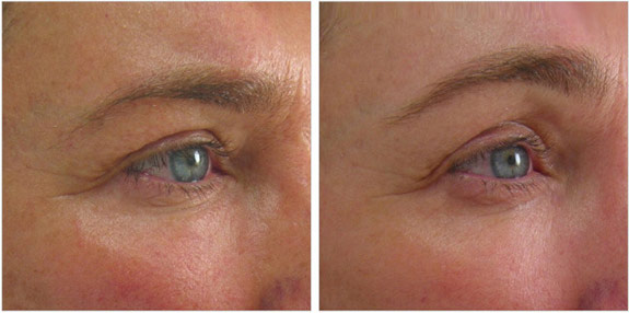 Before And After Photos Mountain View - Ultherapy  - BrowsImage 12