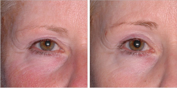 Before And After Photos Mountain View - Ultherapy - Brows Image 13