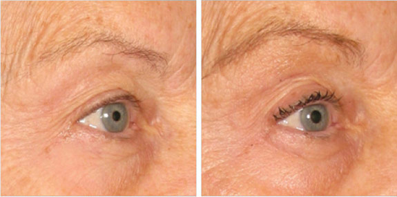 Before And After Photos Mountain View - Ultherapy - Brows Image 02
