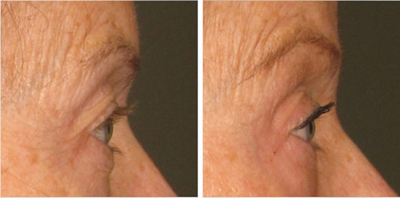 Before And After Photos Mountain View - Ultherapy - Brows Image 03