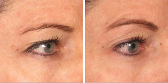 Before And After Photos Mountain View - Ultherapy - Brows Image 04