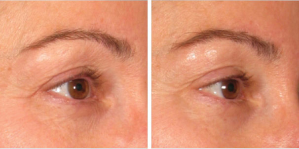 Before And After Photos Mountain View - Ultherapy - Brows Image 05