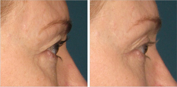 Before And After Photos Mountain View - Ultherapy - Brows Image 06