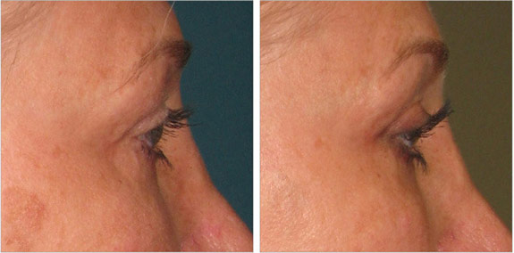 Before And After Photos Mountain View - Ultherapy - Brows Image 07