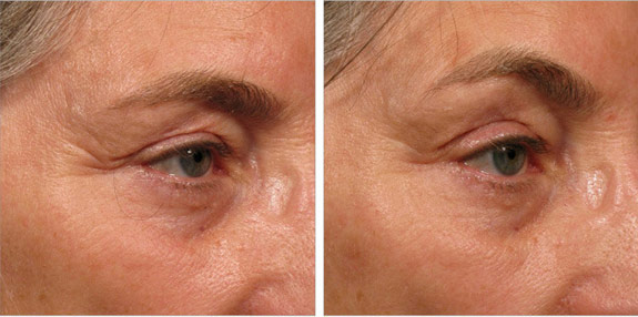 Before And After Photos Mountain View - Ultherapy - Brows Image 08