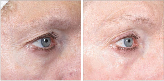 Before And After Photos Mountain View - Ultherapy - Brows Image 09