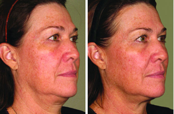 Before And After Photos Mountain View - Ultherapy Image 42