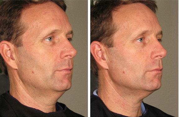Before And After Photos Mountain View - Ultherapy Image 33