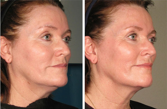 Before And After Photos Mountain View - Ultherapy Image 32