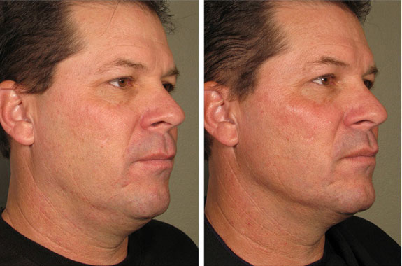 Before And After Photos Mountain View - Ultherapy Image 31