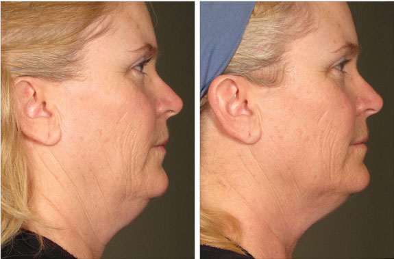 Before And After Photos Mountain View - Ultherapy Image 29