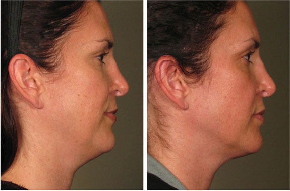 Before And After Photos Mountain View - Ultherapy Image 28