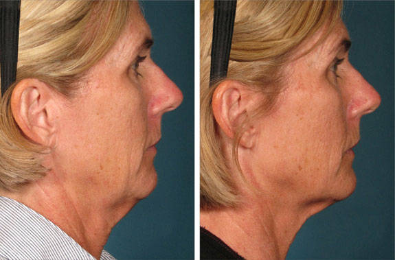 Before And After Photos Mountain View - Ultherapy Image 27