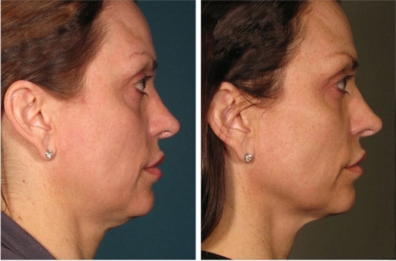 Before And After Photos Mountain View - Ultherapy Image 26