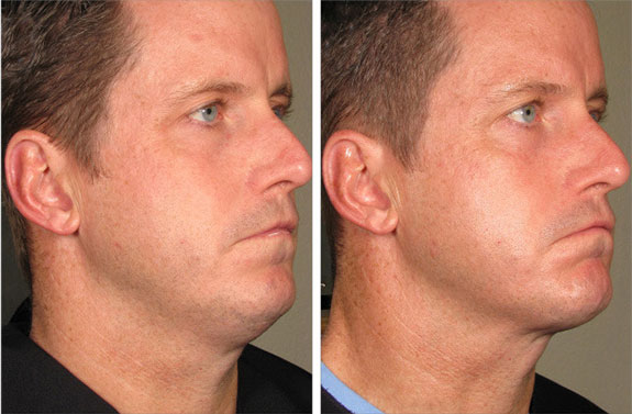 Before And After Photos Mountain View - Ultherapy Image 25