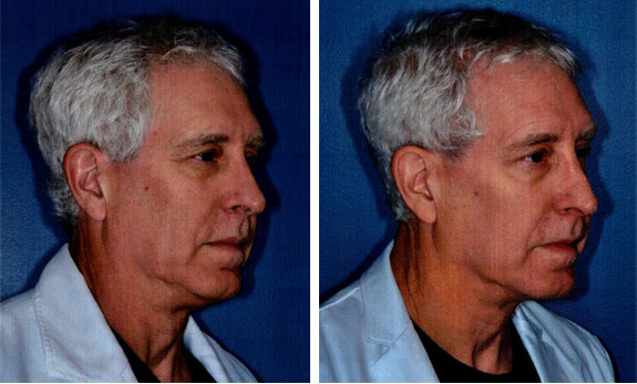 Before And After Photos Mountain View - Ultherapy Image 56