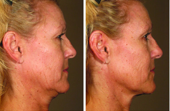 Before And After Photos Mountain View - Ultherapy Image 39