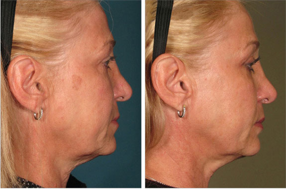Before And After Photos Mountain View - Ultherapy Image 37